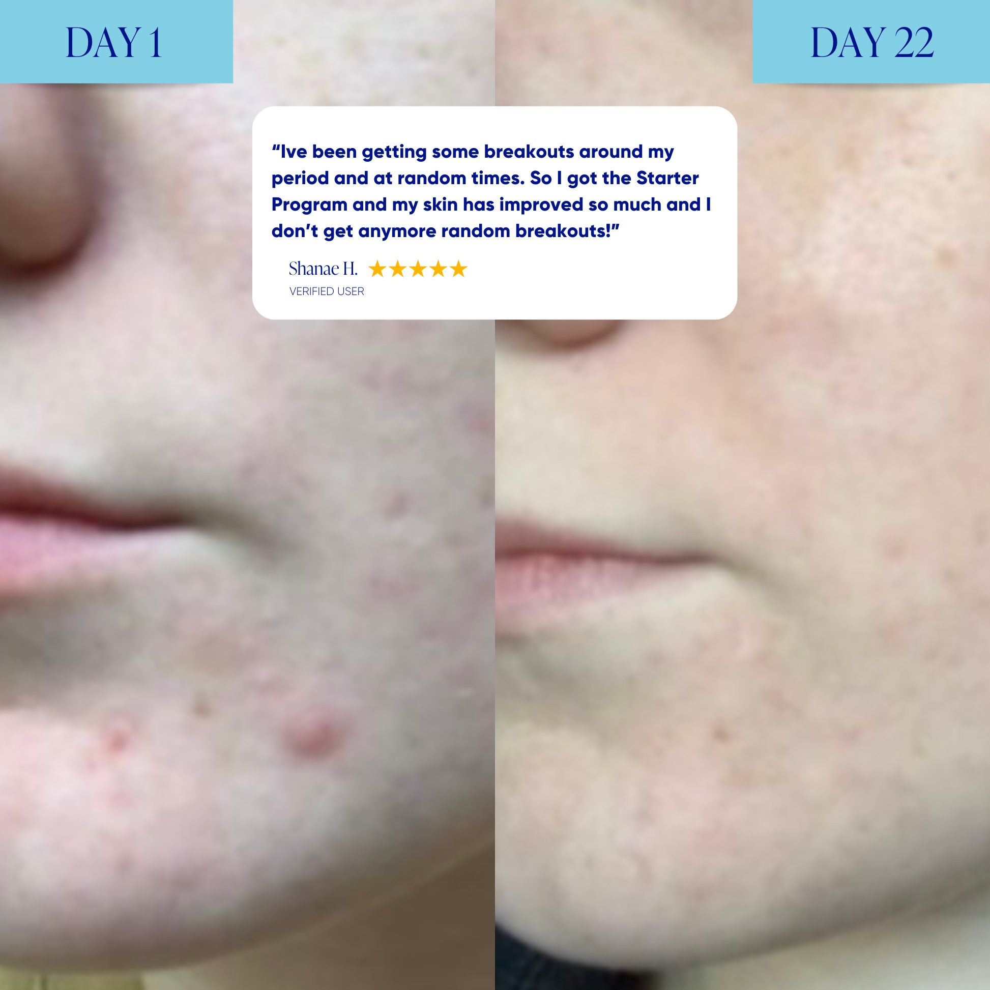 Starter Acne Program™