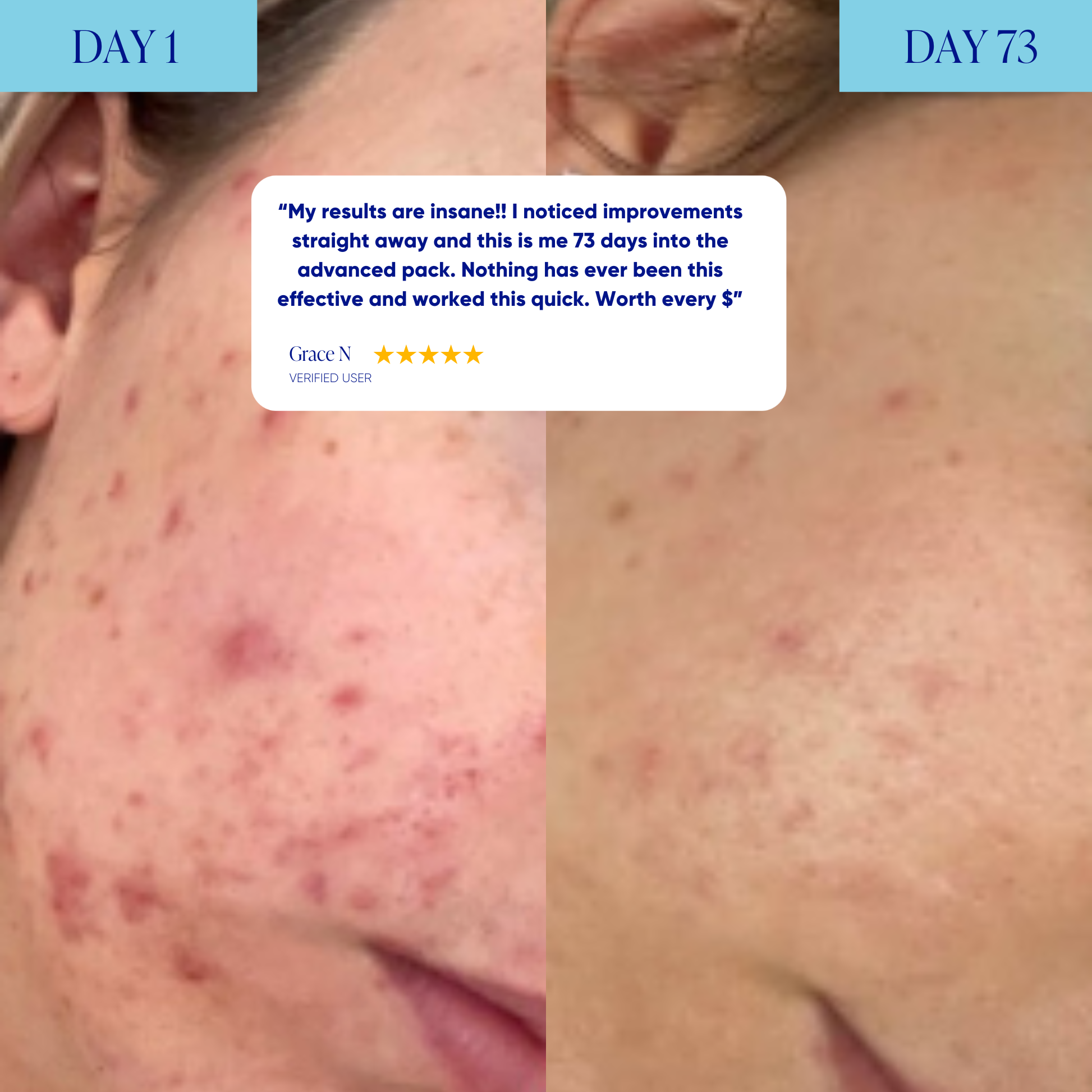 Advanced Acne Program™