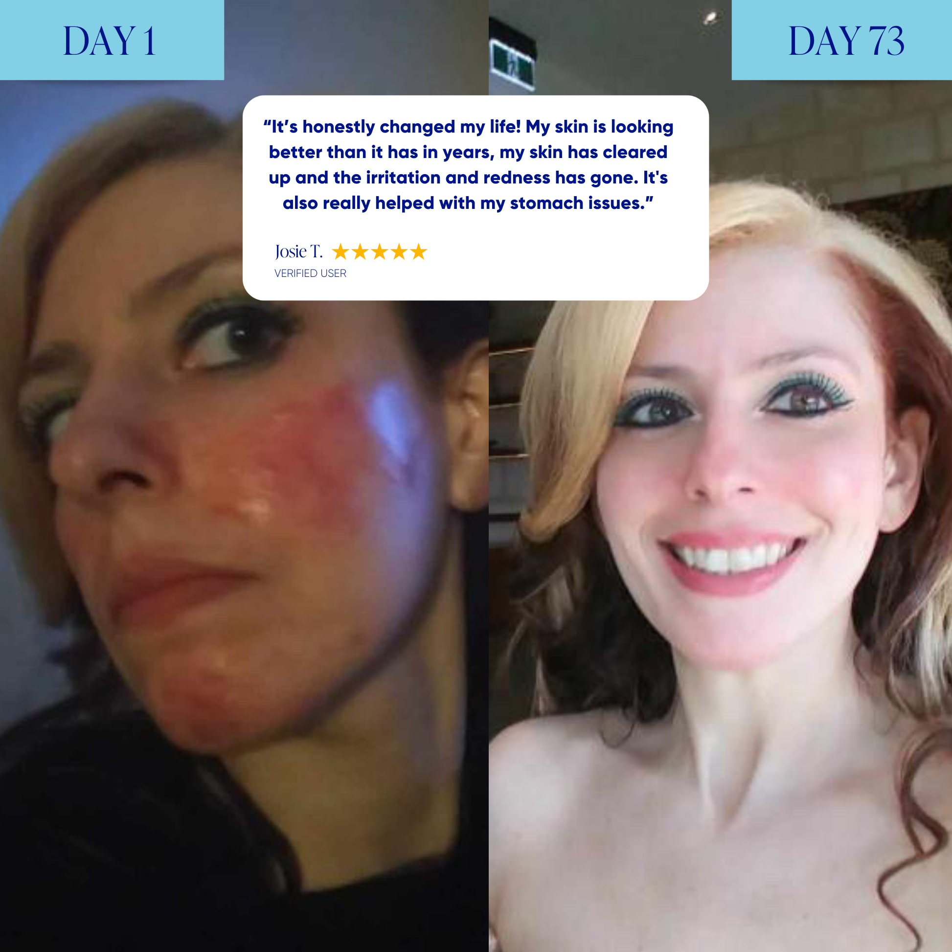 Advanced Acne Program™
