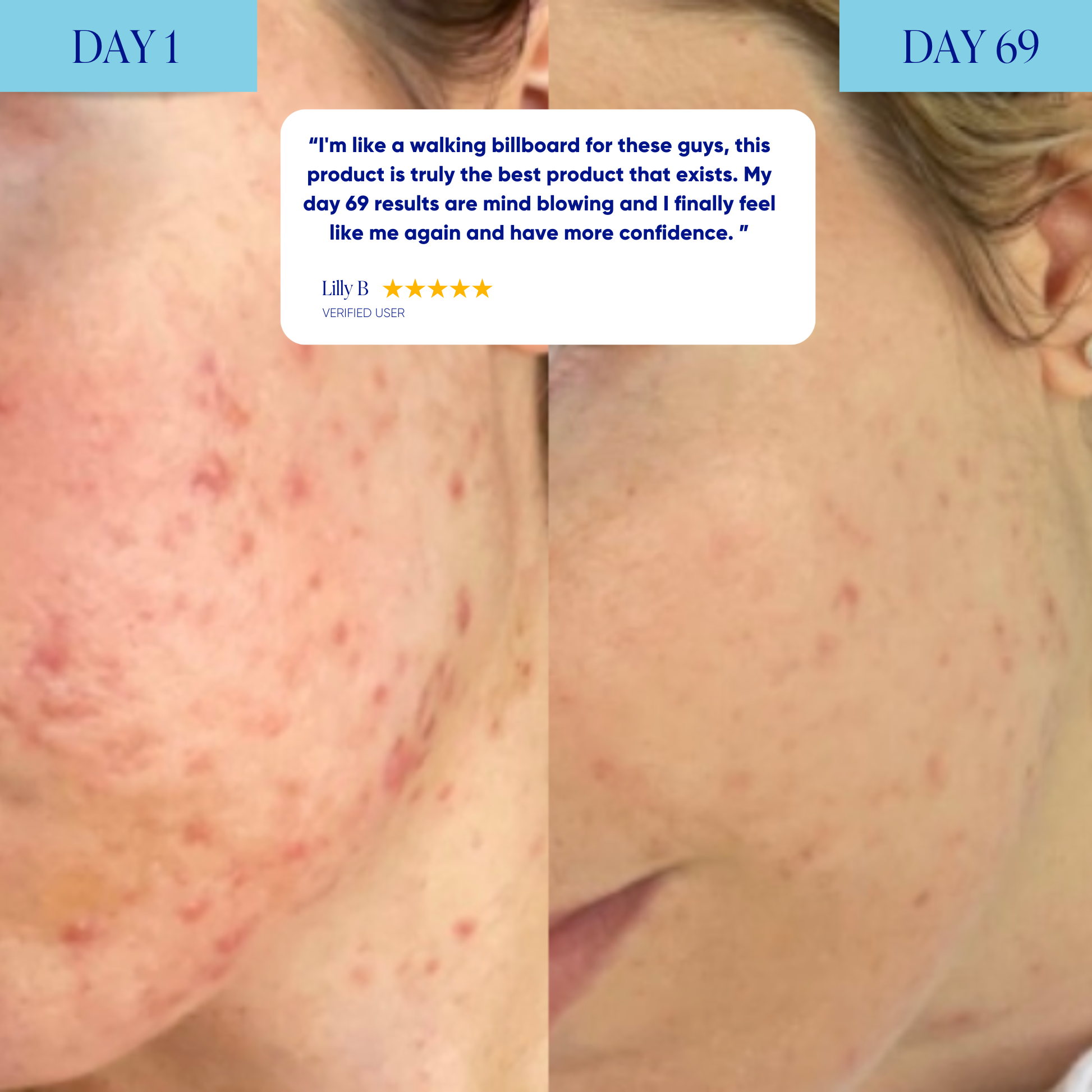 Advanced Acne Program™