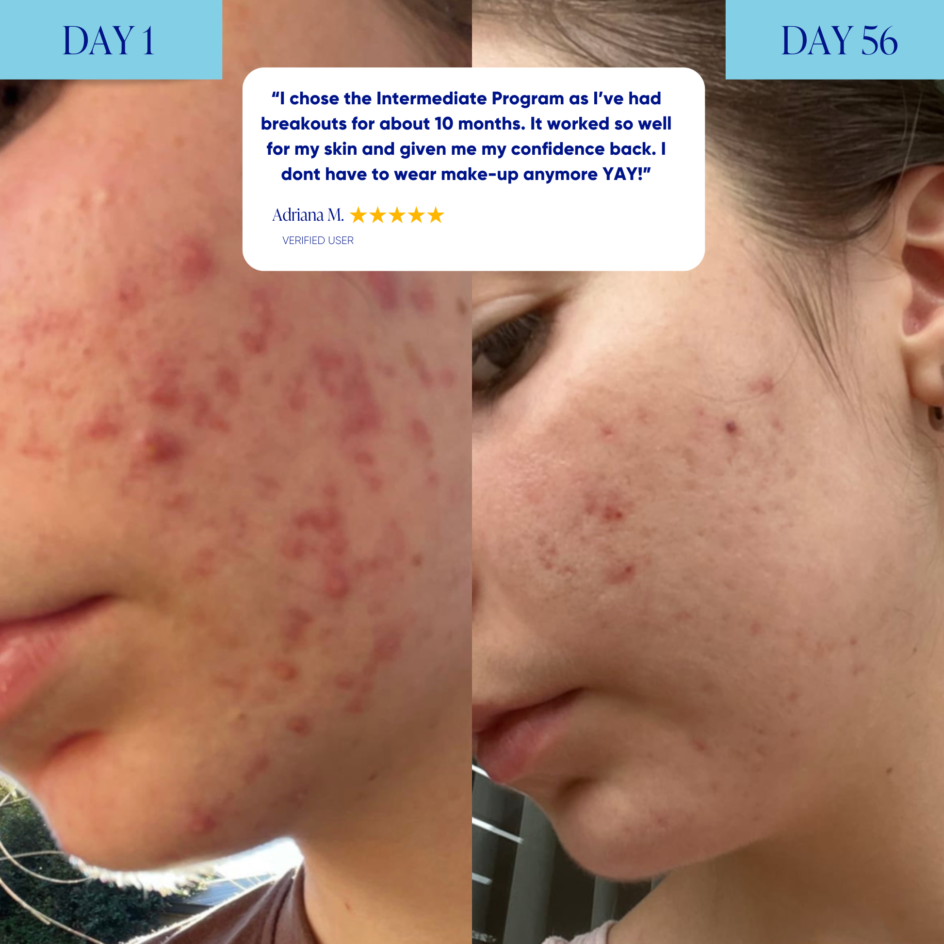 Intermediate Acne Program™