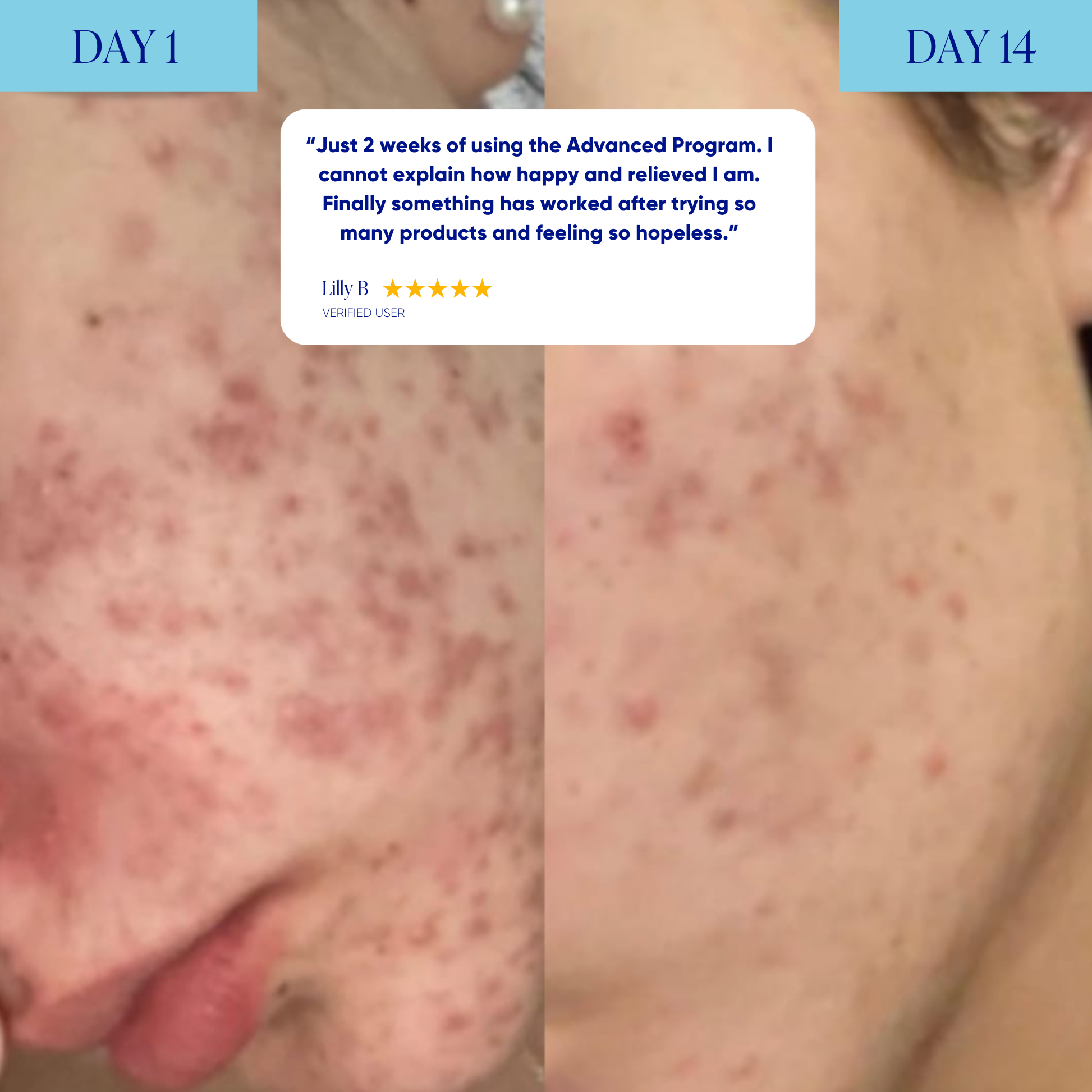 Advanced Acne Program™