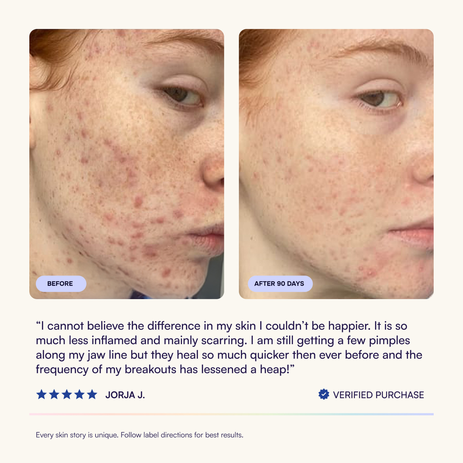 Advanced Acne Program™