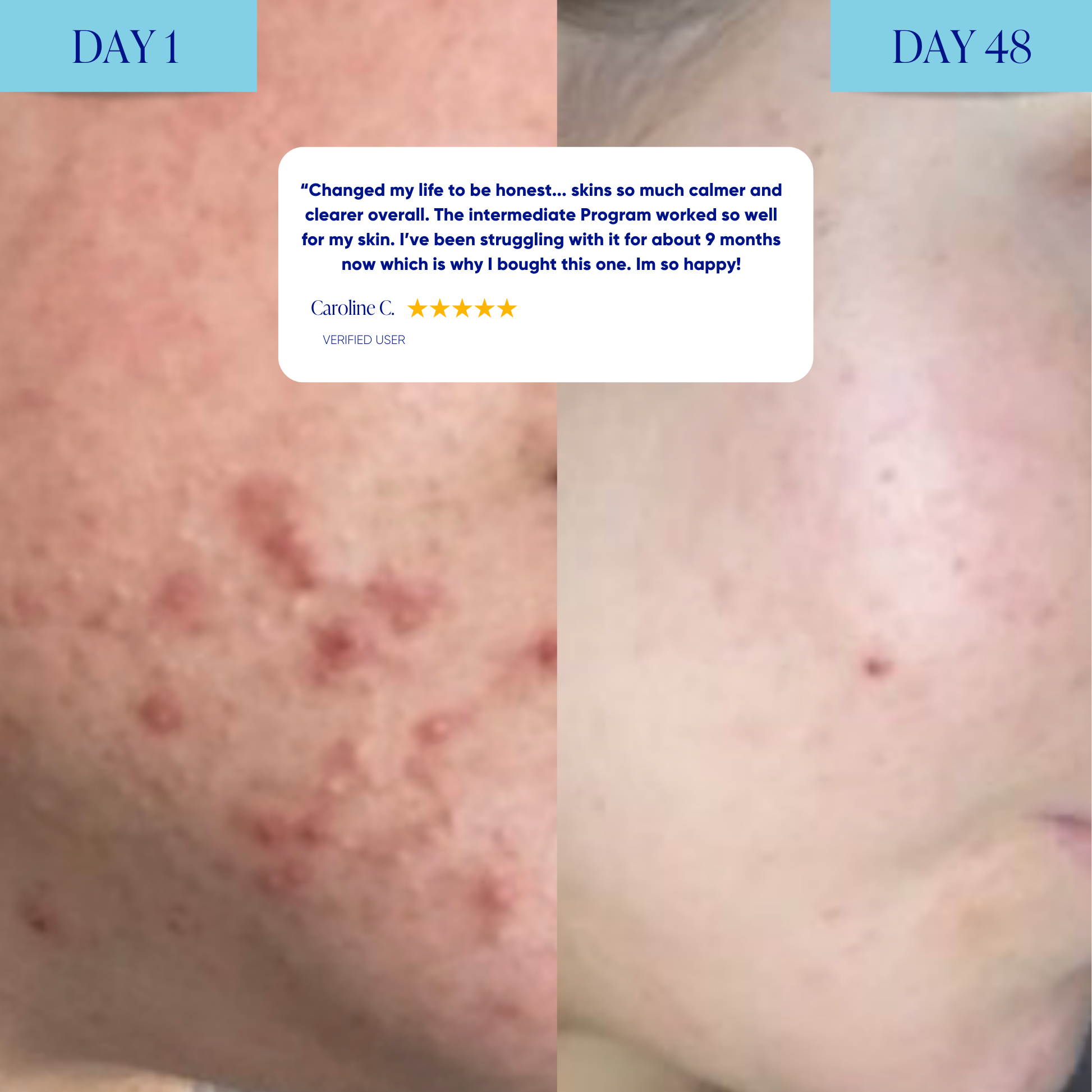 Intermediate Acne Program™