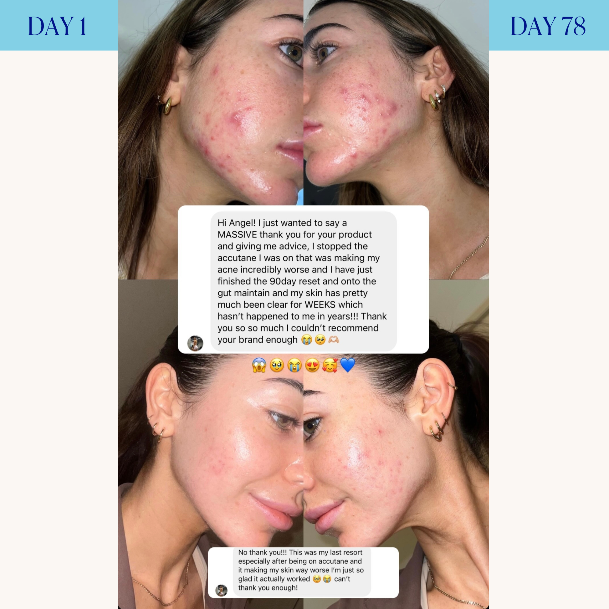 Advanced Acne Program™