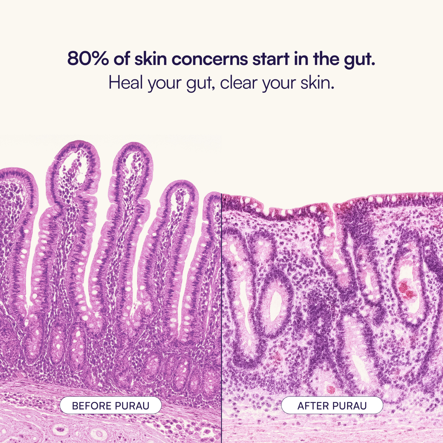 Advanced Acne Program™
