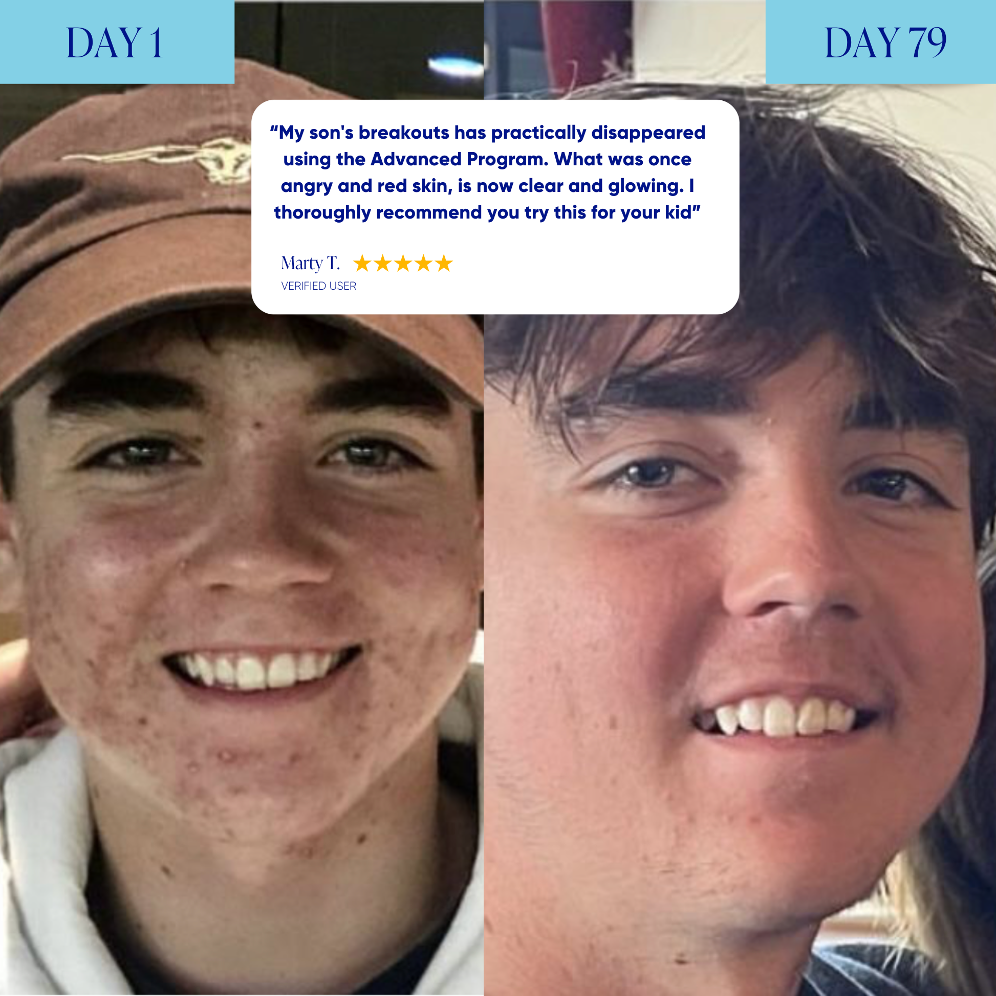 Advanced Acne Program™