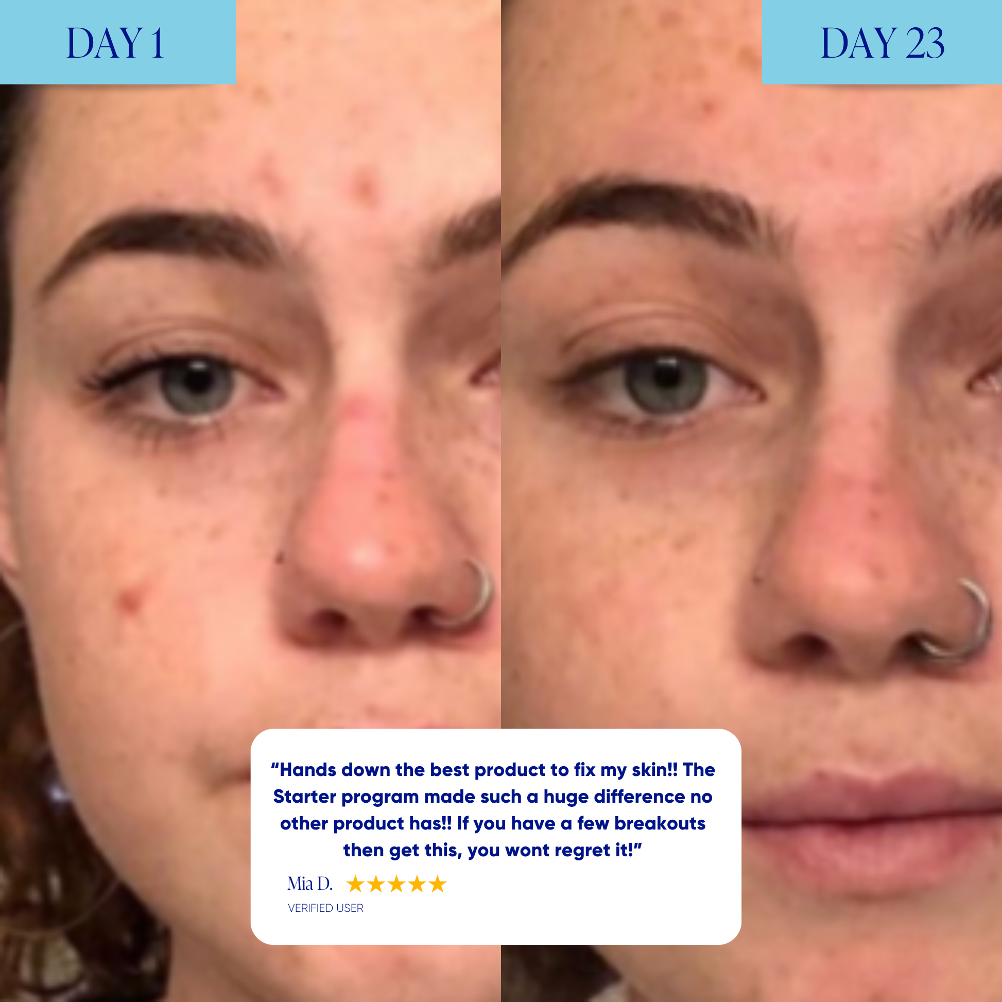 Starter Acne Program™