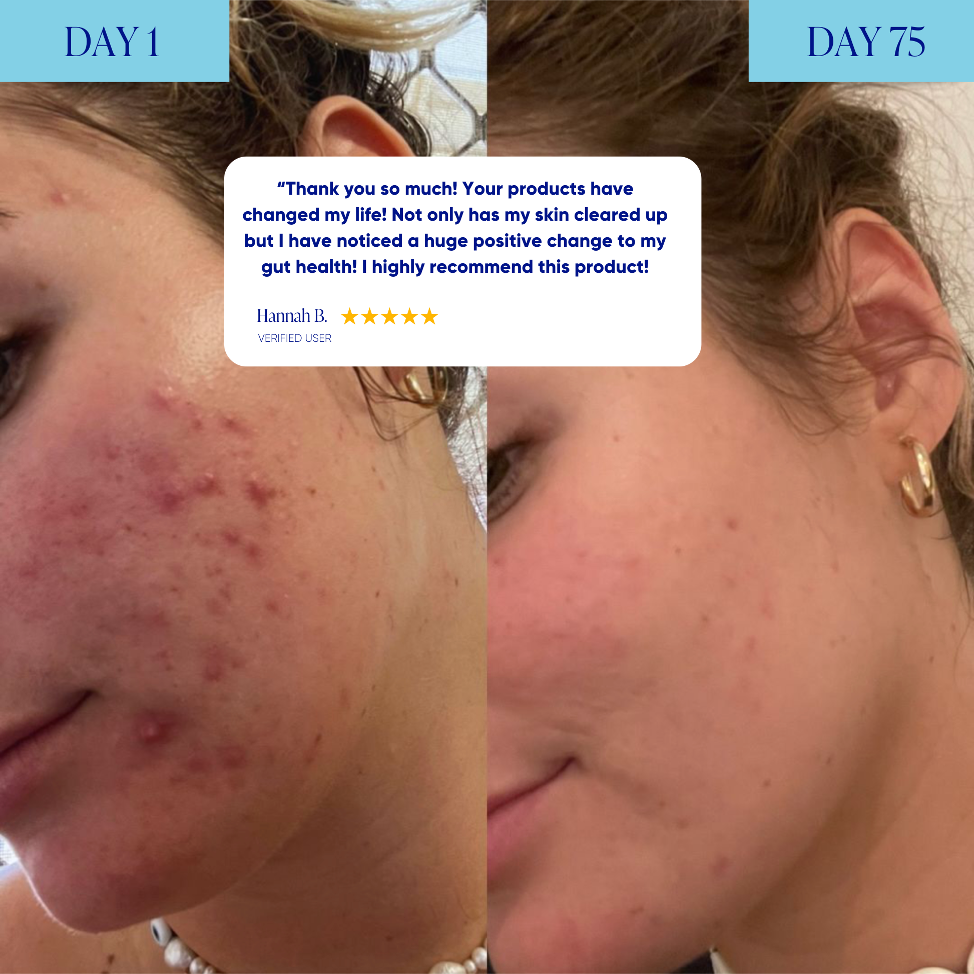 Advanced Acne Program™