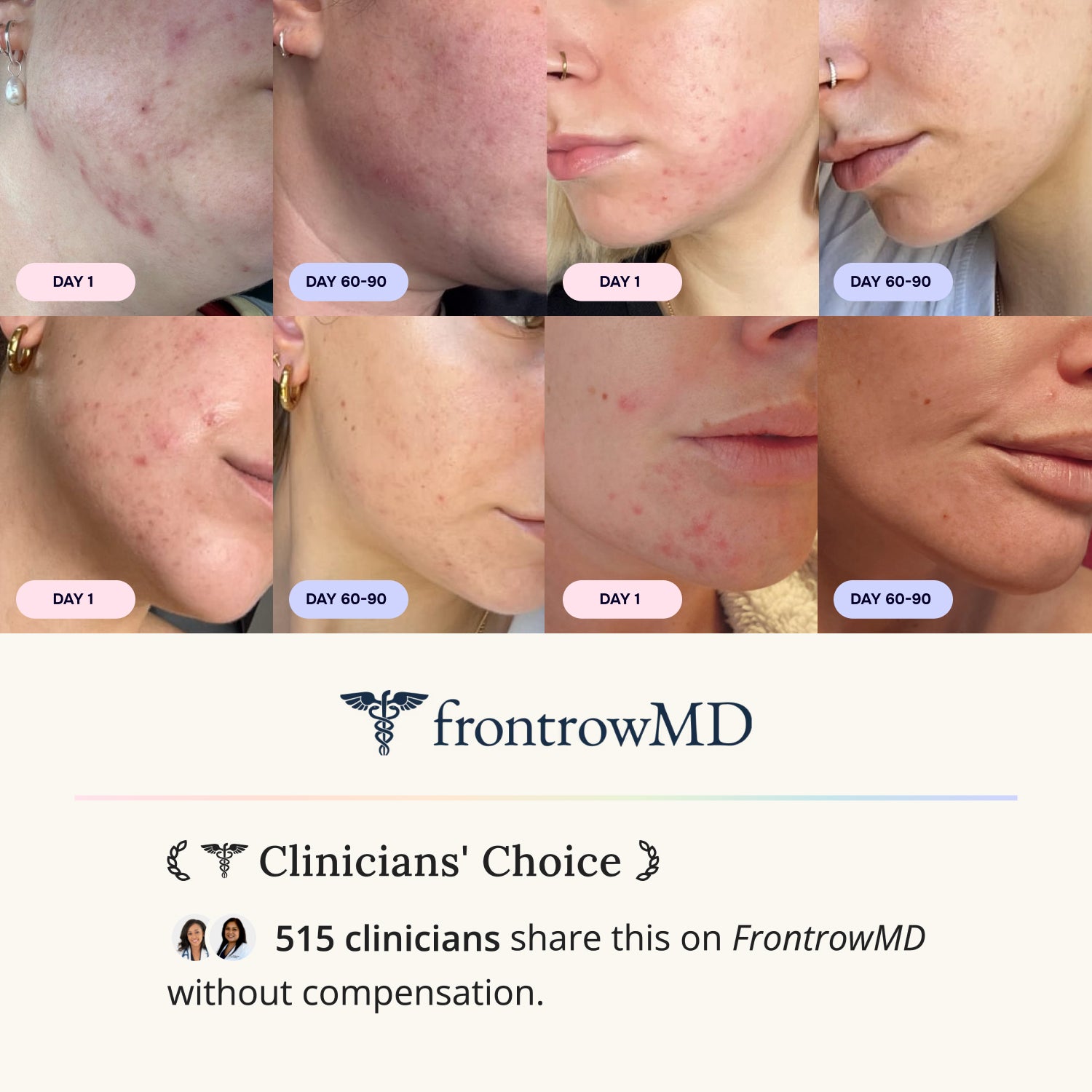 Starter Acne Program™