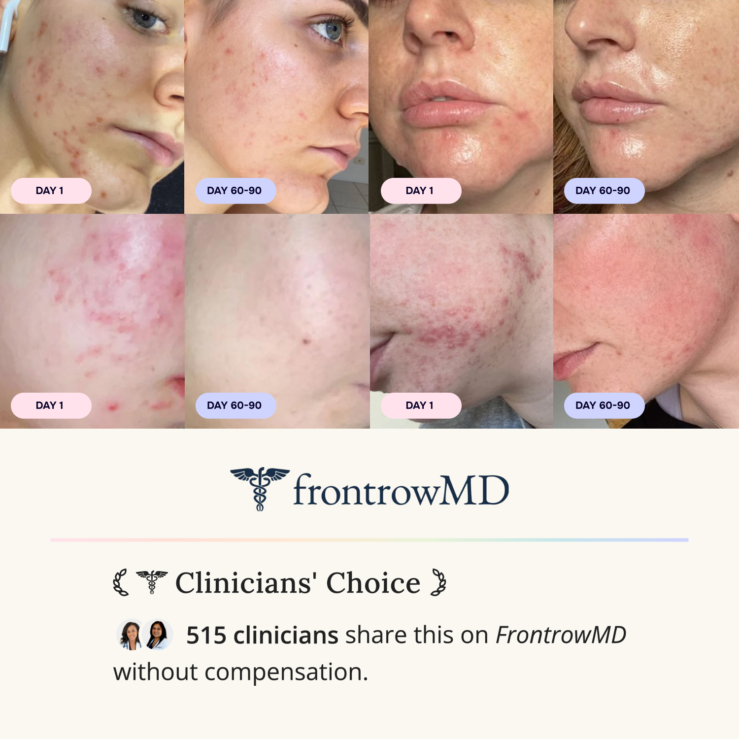 Intermediate Acne Program™