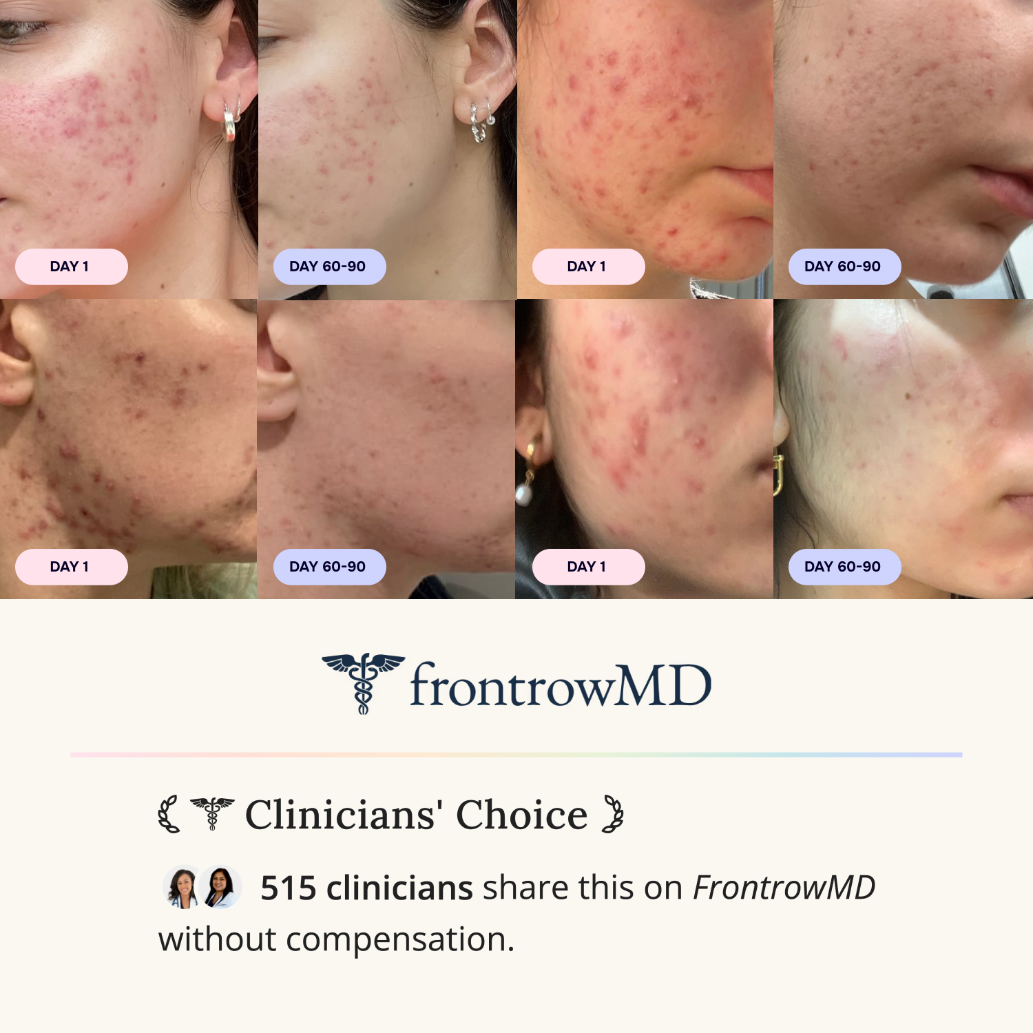 Advanced Acne Program™