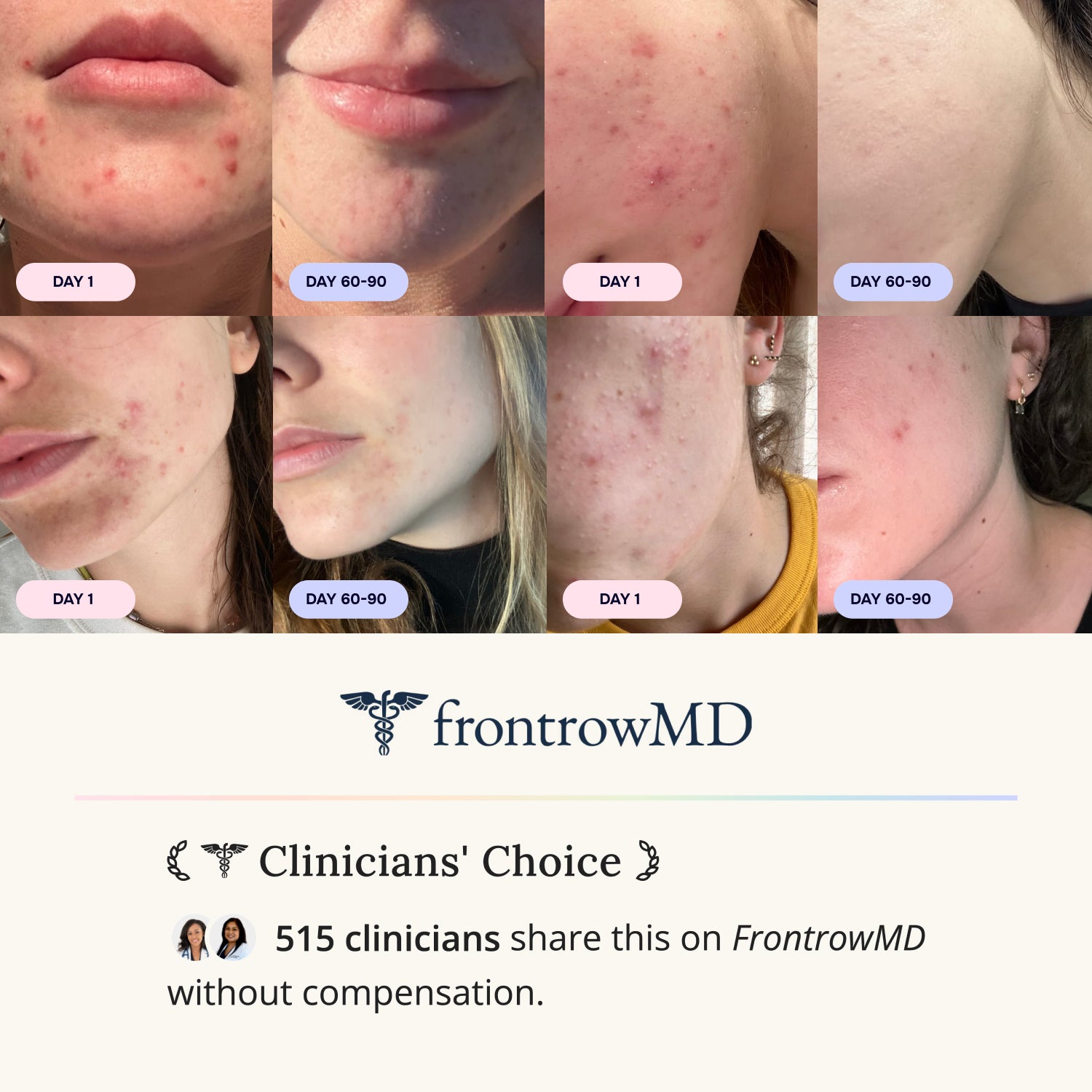 Starter Acne Program™