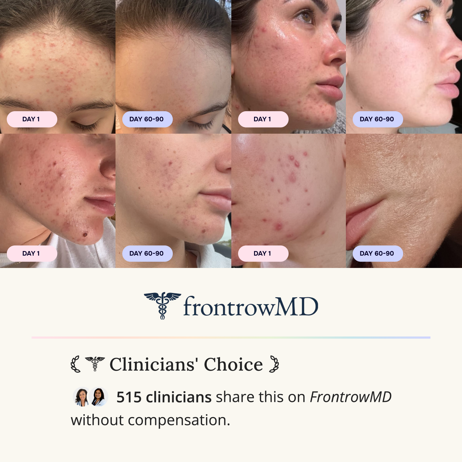 Intermediate Acne Program™