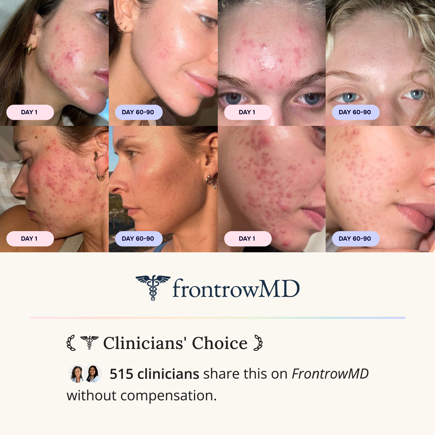 Advanced Acne Program™