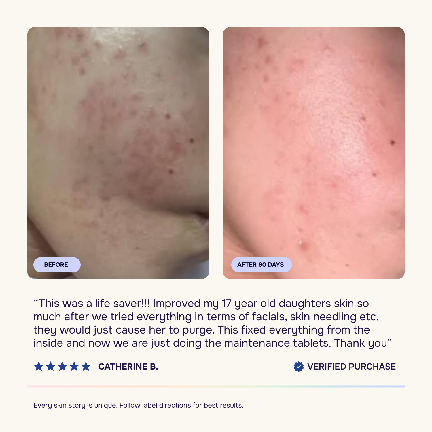 Intermediate Acne Program™