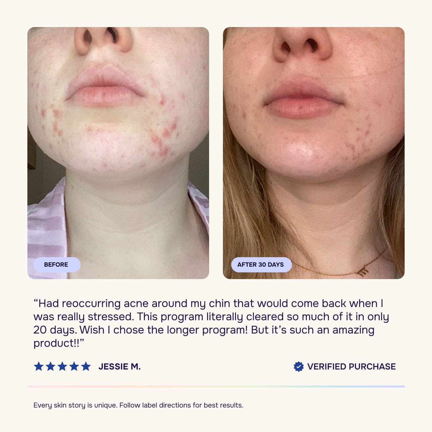 Starter Acne Program™