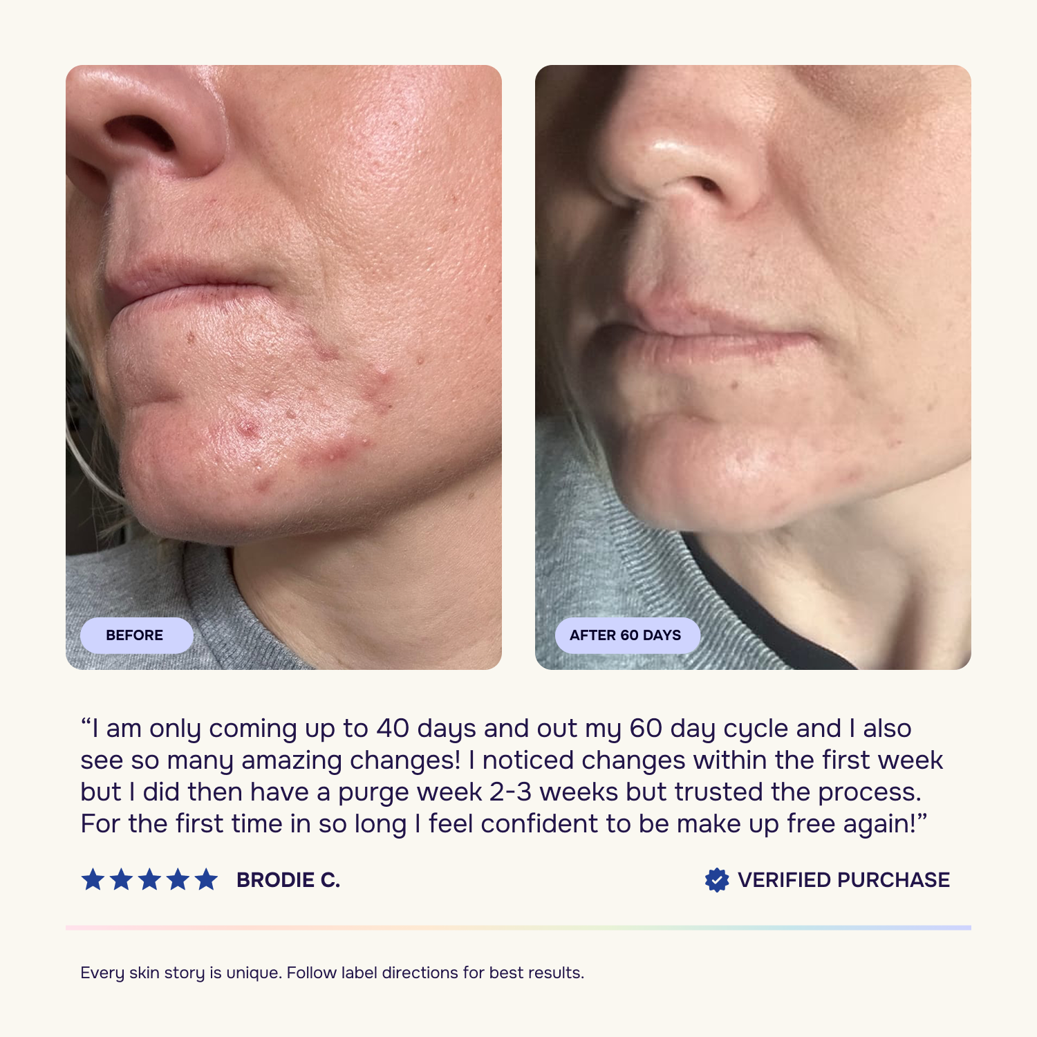 Intermediate Acne Program™