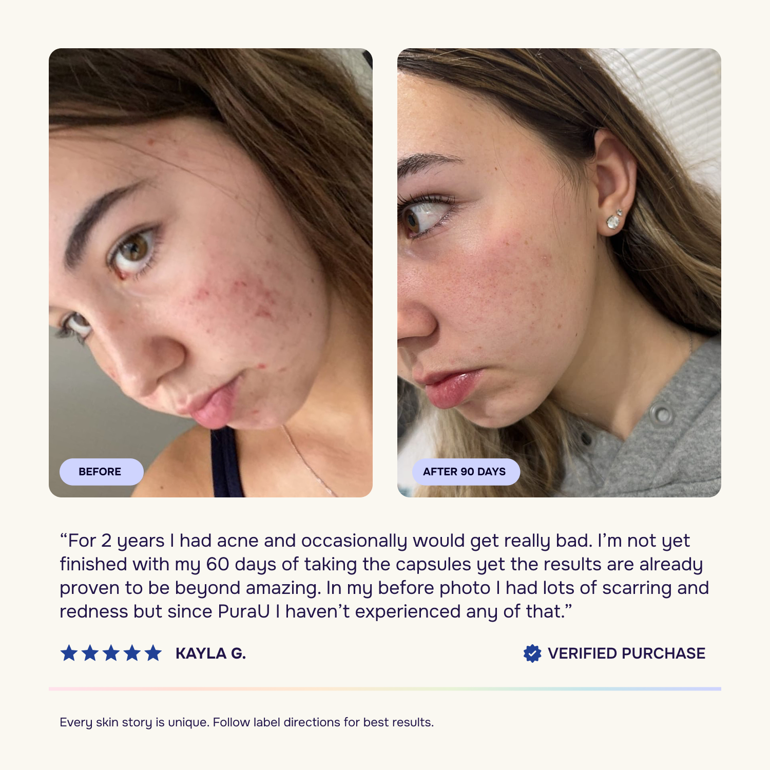 Advanced Acne Program™