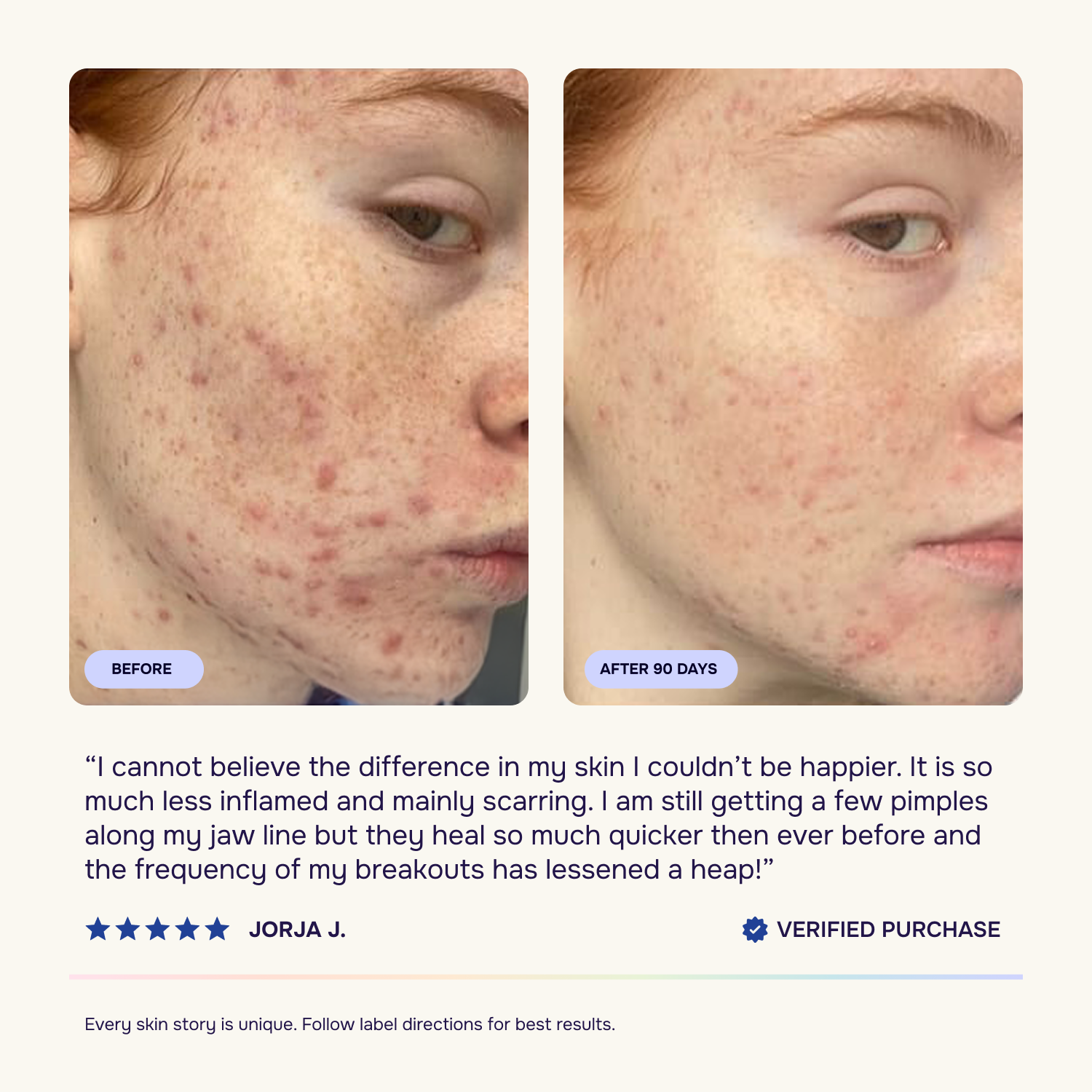 Advanced Acne Program™