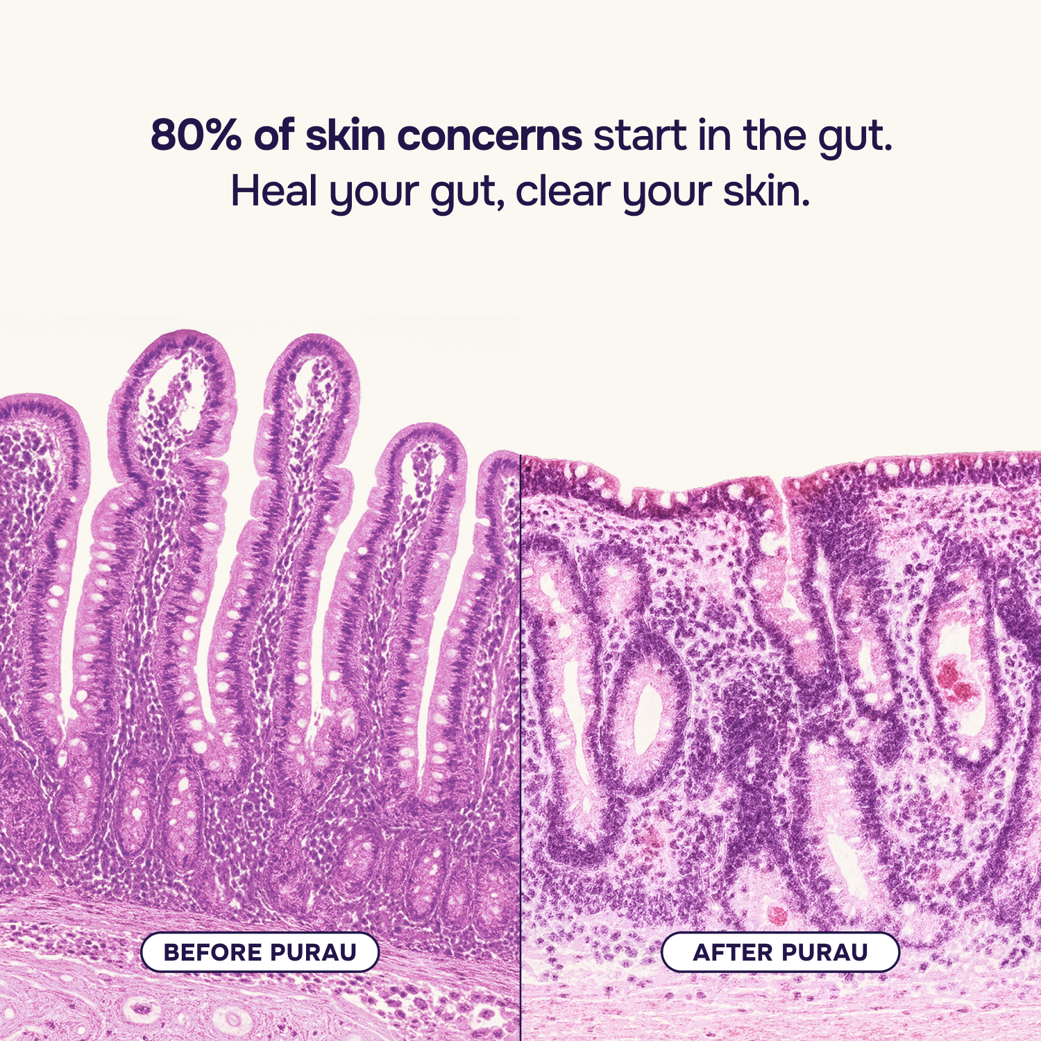 Intermediate Acne Program™