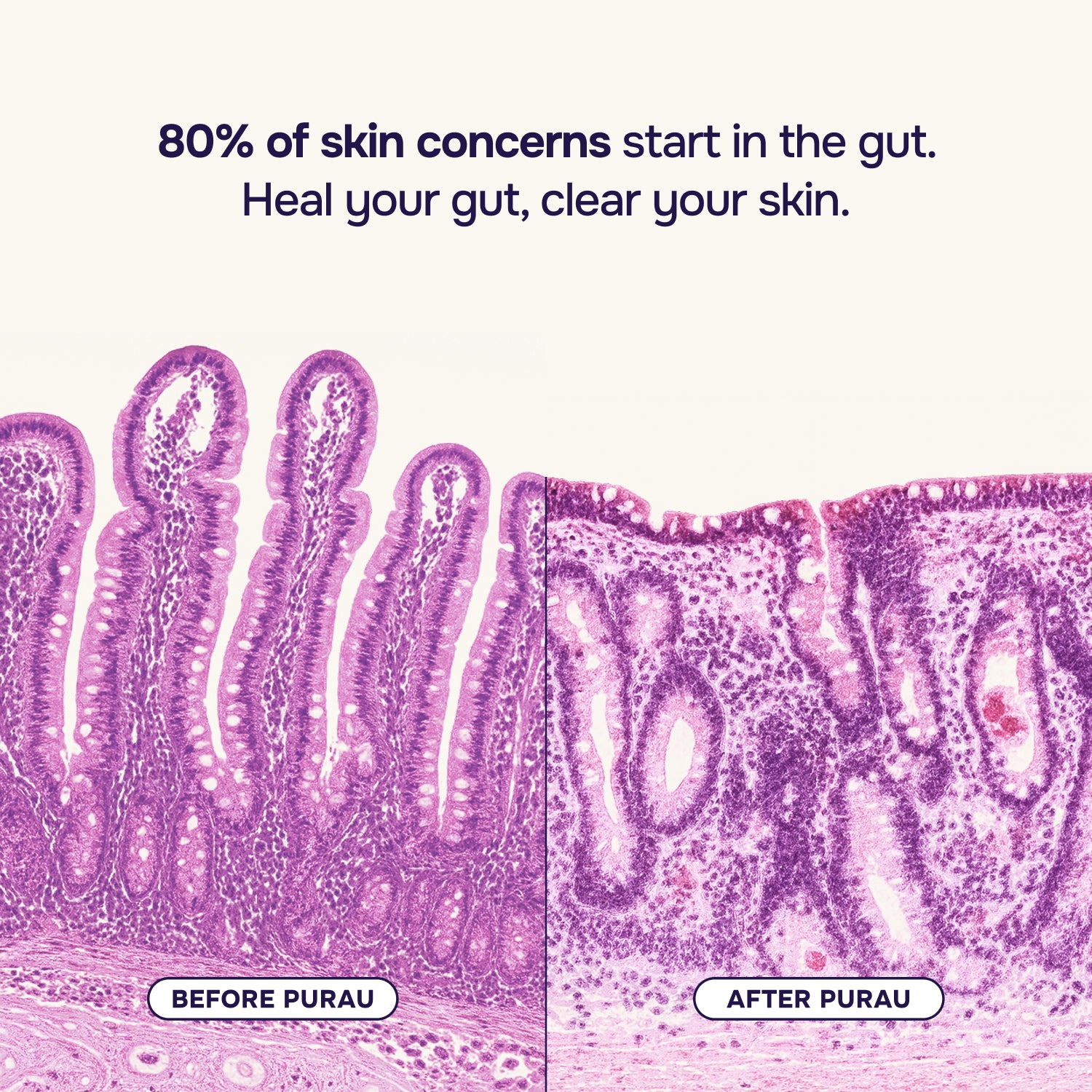 Starter Acne Program™