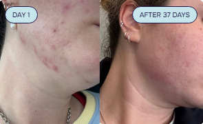 Intermediate Acne Program Acne Assessment Quiz – PuraU