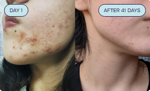 Intermediate Acne Program Acne Assessment Quiz – PuraU