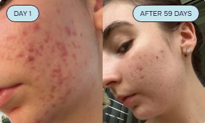 Intermediate Acne Program Acne Assessment Quiz – PuraU